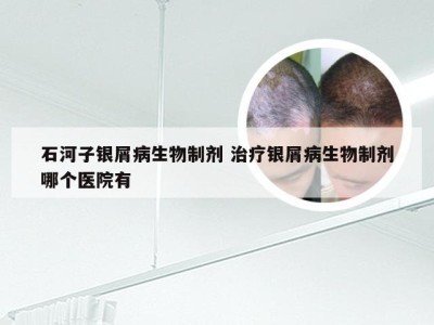 石河子银屑病生物制剂 治疗银屑病生物制剂哪个医院有