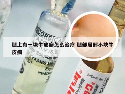 腿上有一块牛皮癣怎么治疗 腿部局部小块牛皮癣