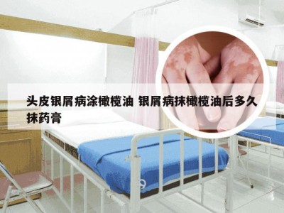 头皮银屑病涂橄榄油 银屑病抹橄榄油后多久抹药膏