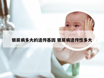 银屑病多大的遗传基因 银屑病遗传性多大
