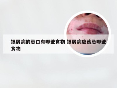 银屑病的忌口有哪些食物 银屑病应该忌哪些食物