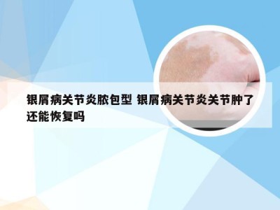银屑病关节炎脓包型 银屑病关节炎关节肿了还能恢复吗