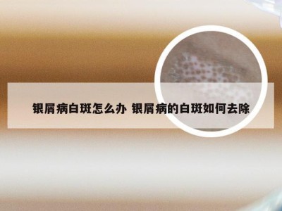 银屑病白斑怎么办 银屑病的白斑如何去除