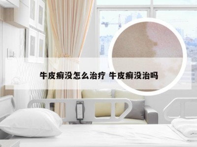 牛皮癣没怎么治疗 牛皮癣没治吗