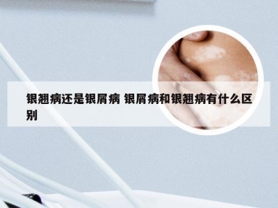 银翘病还是银屑病 银屑病和银翘病有什么区别