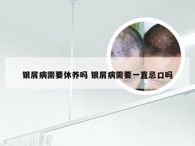 银屑病需要休养吗 银屑病需要一直忌口吗