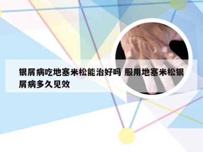 银屑病吃地塞米松能治好吗 服用地塞米松银屑病多久见效