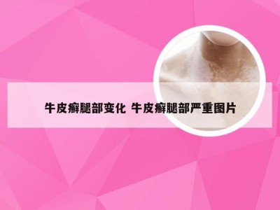 牛皮癣腿部变化 牛皮癣腿部严重图片
