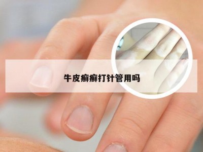 牛皮癣癣打针管用吗