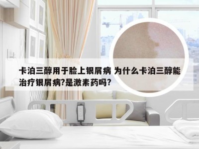 卡泊三醇用于脸上银屑病 为什么卡泊三醇能治疗银屑病?是激素药吗?