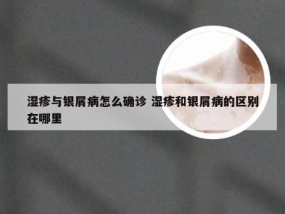 湿疹与银屑病怎么确诊 湿疹和银屑病的区别在哪里