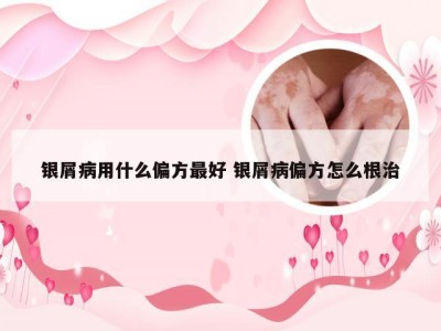 银屑病用什么偏方最好 银屑病偏方怎么根治