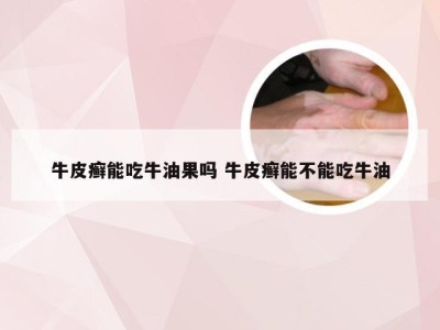 牛皮癣能吃牛油果吗 牛皮癣能不能吃牛油