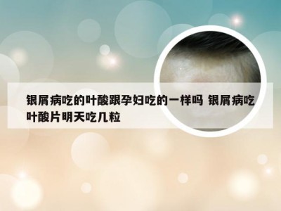 银屑病吃的叶酸跟孕妇吃的一样吗 银屑病吃叶酸片明天吃几粒