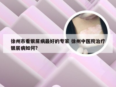 徐州市看银屑病最好的专家 徐州中医院治疗银屑病如何?