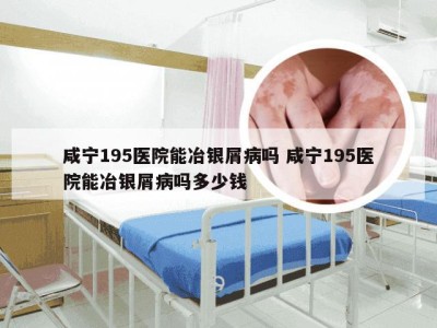 咸宁195医院能冶银屑病吗 咸宁195医院能冶银屑病吗多少钱