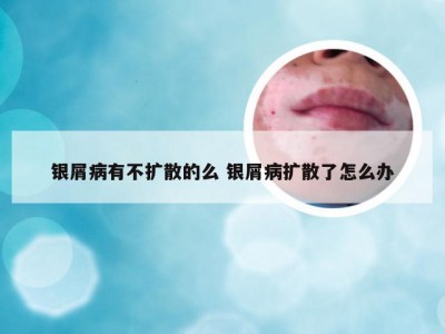 银屑病有不扩散的么 银屑病扩散了怎么办