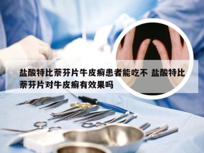 盐酸特比萘芬片牛皮癣患者能吃不 盐酸特比萘芬片对牛皮癣有效果吗
