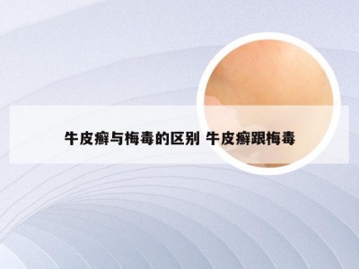牛皮癣与梅毒的区别 牛皮癣跟梅毒