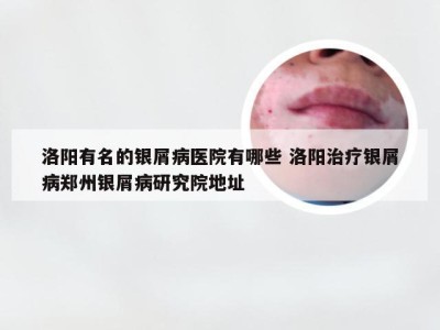 洛阳有名的银屑病医院有哪些 洛阳治疗银屑病郑州银屑病研究院地址