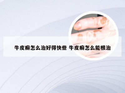 牛皮癣怎么治好得快些 牛皮癣怎么能根治