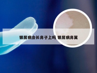 银屑病会长鼻子上吗 银屑病鼻翼