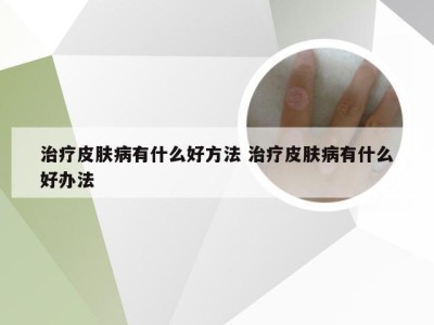 治疗皮肤病有什么好方法 治疗皮肤病有什么好办法