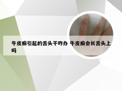 牛皮癣引起的舌头干咋办 牛皮癣会长舌头上吗