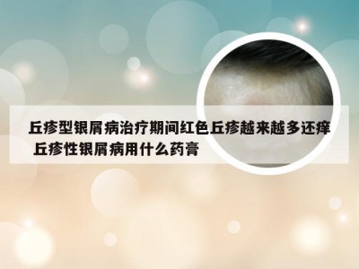 丘疹型银屑病治疗期间红色丘疹越来越多还痒 丘疹性银屑病用什么药膏
