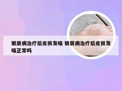银屑病治疗后皮损发暗 银屑病治疗后皮损发暗正常吗