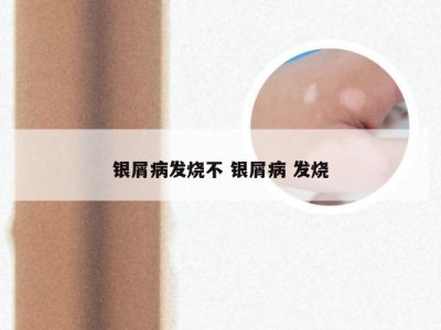 银屑病发烧不 银屑病 发烧