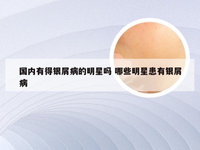 国内有得银屑病的明星吗 哪些明星患有银屑病