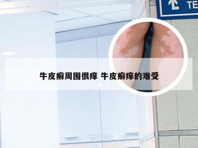 牛皮癣周围很痒 牛皮癣痒的难受