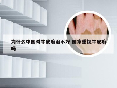 为什么中国对牛皮癣治不好 国家重视牛皮癣吗