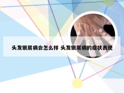 头发银屑病会怎么样 头发银屑病的症状表现