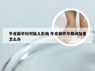 牛皮癣孕妇对胎儿影响 牛皮癣怀孕期间加重怎么办