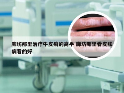 廊坊那里治疗牛皮癣的高手 廊坊哪里看皮肤病看的好