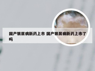 国产银屑病新药上市 国产银屑病新药上市了吗