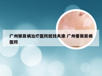 广州银屑病治疗医院就找夫康 广州看银屑病医院