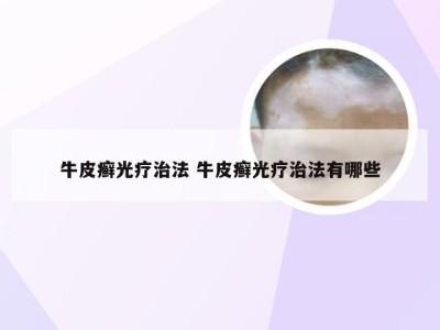 牛皮癣光疗治法 牛皮癣光疗治法有哪些