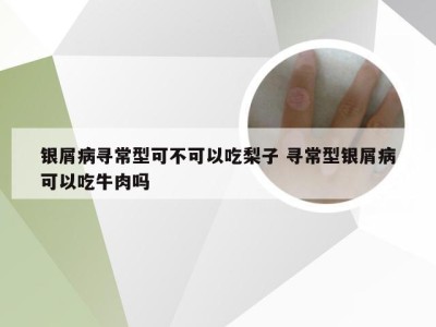 银屑病寻常型可不可以吃梨子 寻常型银屑病可以吃牛肉吗