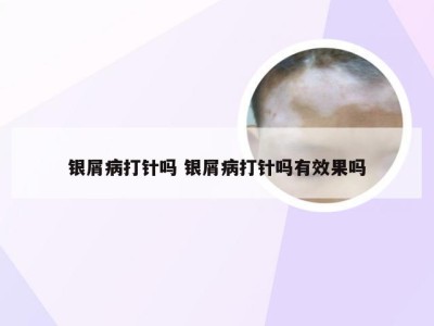 银屑病打针吗 银屑病打针吗有效果吗