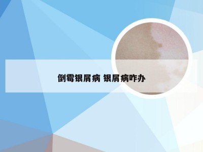 倒霉银屑病 银屑病咋办
