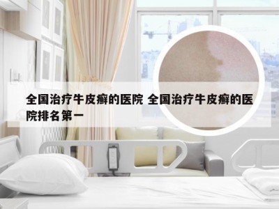 全国治疗牛皮癣的医院 全国治疗牛皮癣的医院排名第一