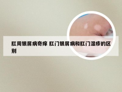 肛周银屑病奇痒 肛门银屑病和肛门湿疹的区别