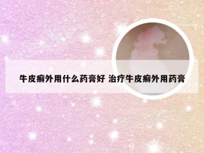 牛皮癣外用什么药膏好 治疗牛皮癣外用药膏