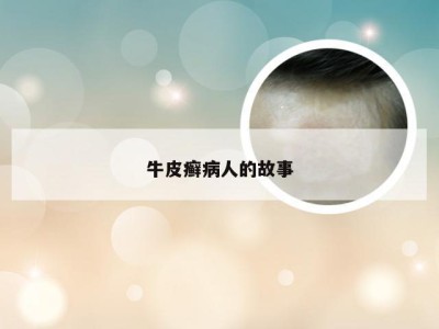 牛皮癣病人的故事