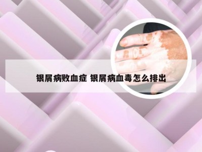 银屑病败血症 银屑病血毒怎么排出