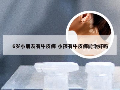 6岁小朋友有牛皮癣 小孩有牛皮癣能治好吗