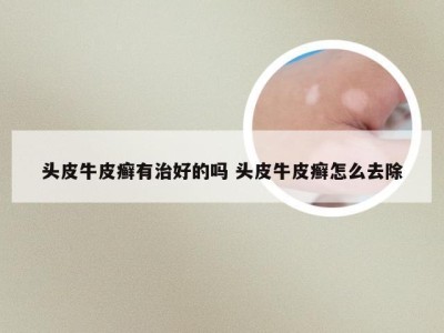 头皮牛皮癣有治好的吗 头皮牛皮癣怎么去除